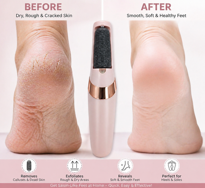 Electric Foot Callus Remover – Rechargeable Pedicure Tool